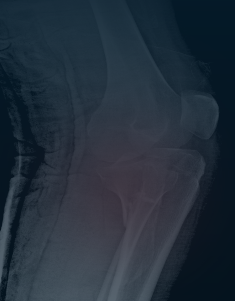 Fractures