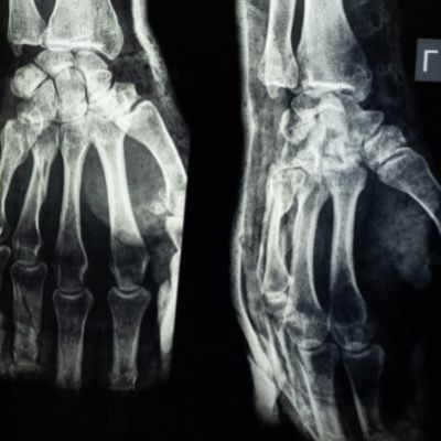 X-ray of a man who suffered a horrific crush injury to his - MEDizzy