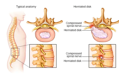 cross-section of a herniated disc