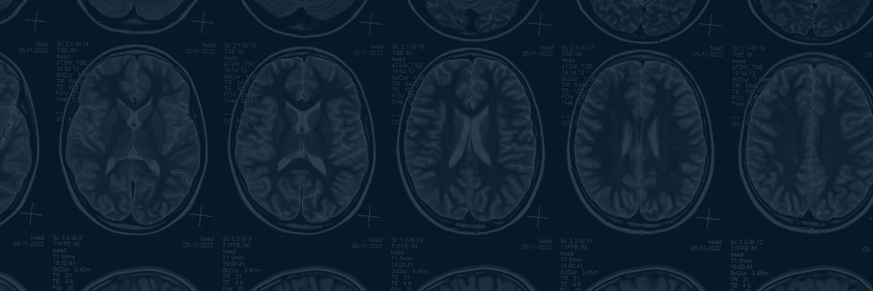 Recognizing Signs of Traumatic Brain Injury After an Accident